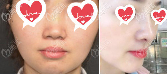 北京柏麗隆鼻案例 北京柏麗隆鼻案例