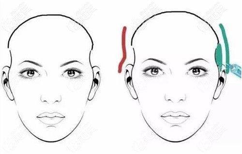 填充太陽穴凹陷選擇玻尿酸哈哈四自體脂肪 填充太陽穴凹陷選擇玻尿酸哈哈四自體脂肪