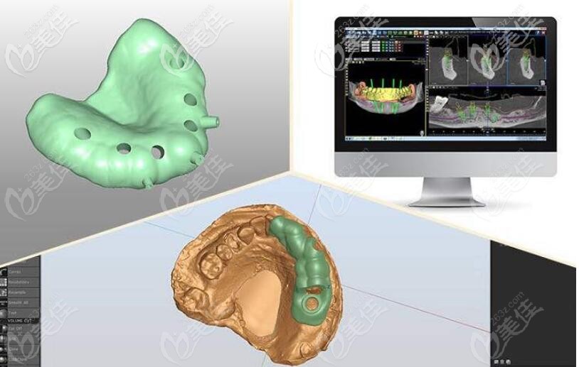 溫州愛牙故事數(shù)字化導(dǎo)板技術(shù)