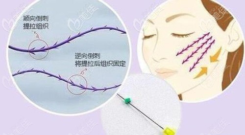 衰老型法令紋用埋線改善