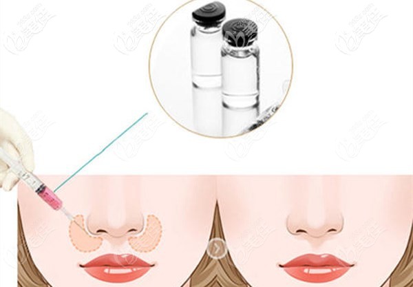注射法改善鼻基底凹陷導(dǎo)致的法令紋