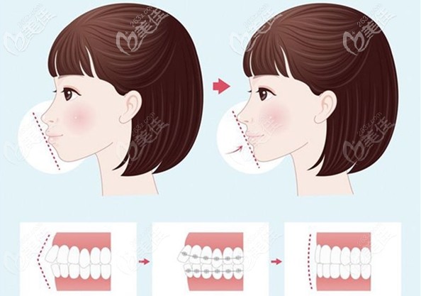 骨性齙牙做正畸后的側(cè)面效果