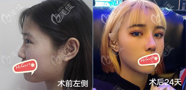 雙眼皮修復(fù)+肋軟骨隆鼻術(shù)后一個月對比效果