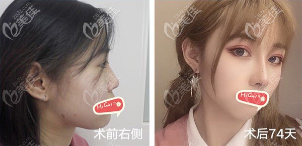 用1個案例展示成都西區(qū)醫(yī)院做全切雙眼皮修復(fù)和肋骨鼻綜合的效果