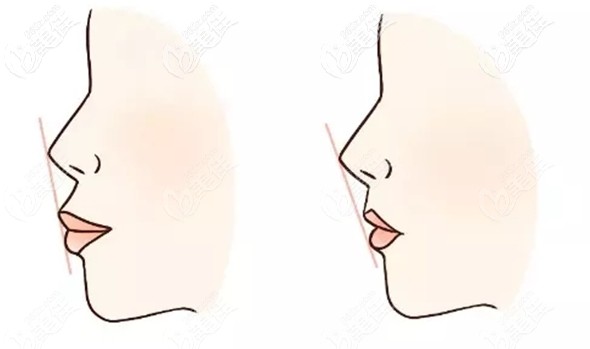 骨性齙牙凸嘴是做正頜還是正畸好呢