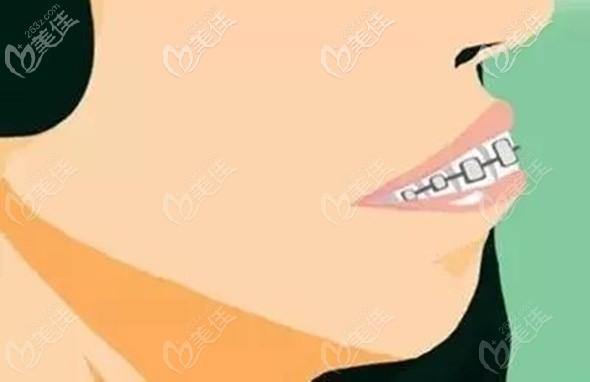 骨性二類齙牙做正頜手術(shù)還是正畸,猶豫良久選擇了帶鋼牙套矯正