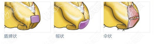 成都西區(qū)醫(yī)院8C骨雕鼻技術(shù)優(yōu)勢