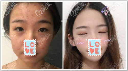 德國(guó)艾pcl線v8全臉提升三個(gè)月效果對(duì)比圖