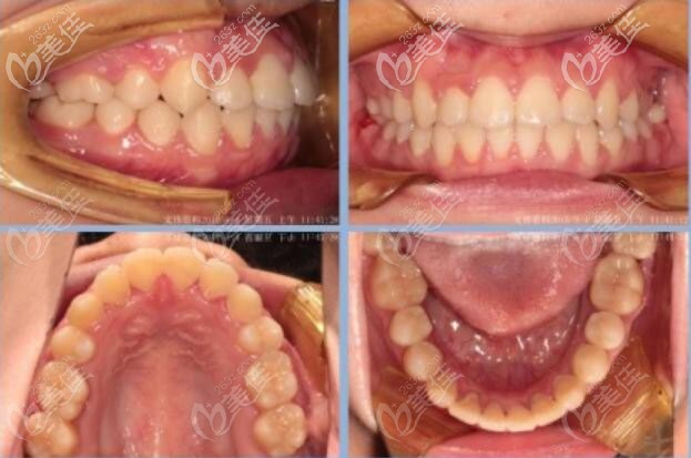 婁底愛牙邦口腔牙齒矯正后 婁底愛牙邦口腔牙齒矯正后