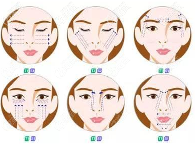 面部埋線提升常見的部位
