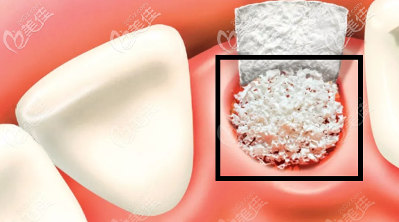 種植牙需要的骨粉