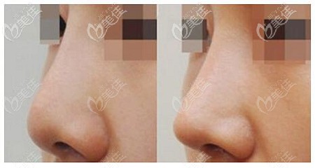 東莞天后耳軟骨隆鼻效果前后對比