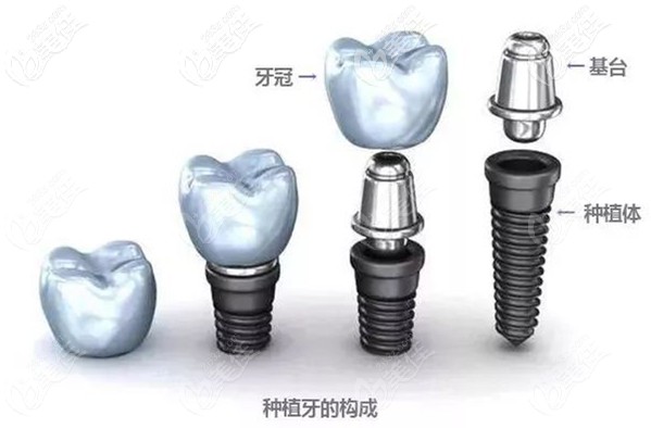 國產(chǎn)種植體和進口種植體的區(qū)別 國產(chǎn)種植體和進口種植體的區(qū)別