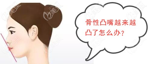 骨性凸嘴會越來越凸嗎