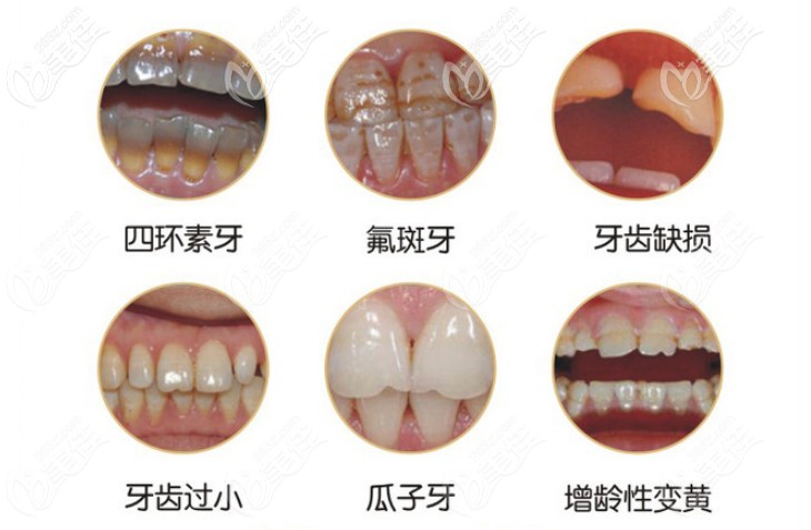那些牙齒需要修復(fù) 那些牙齒需要修復(fù)