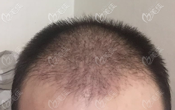 植發(fā)術(shù)后脫落期，原生發(fā)會(huì)有掉落情況