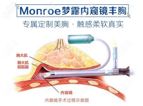 廣東美恩劉祥廈醫(yī)生隆胸怎么樣 廣東美恩劉祥廈醫(yī)生隆胸怎么樣