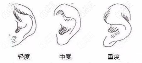 杯狀耳的程度 杯狀耳的程度