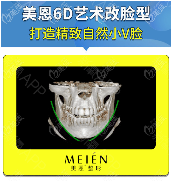 廣東美恩劉祥廈醫(yī)生磨骨怎么樣 廣東美恩劉祥廈醫(yī)生磨骨怎么樣