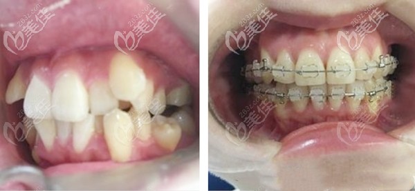 在<!--<i data=20240703-sp></i>-->星諾口腔矯正虎牙的經(jīng)歷