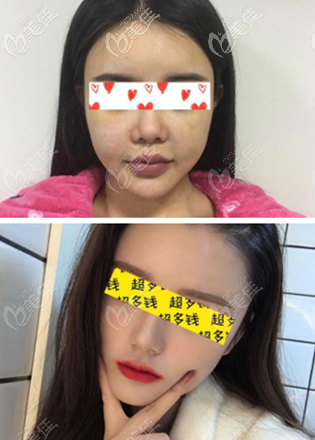 重慶鄭荃麗格可以做面部脂肪填充失敗修復(fù)嗎