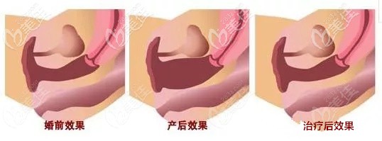 激光縮陰可達到2指的效果