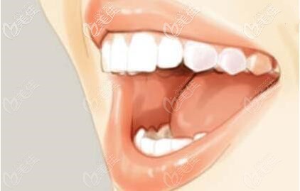 MBT直絲弓矯正 MBT直絲弓矯正