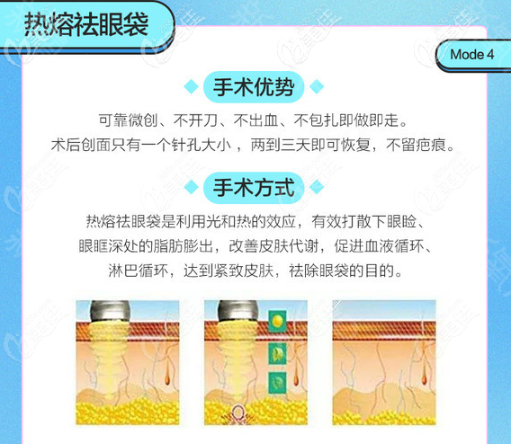 熱效溶脂祛眼袋手術(shù)方法和優(yōu)勢(shì)介紹 熱效溶脂祛眼袋手術(shù)方法和優(yōu)勢(shì)介紹