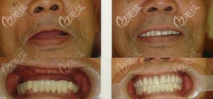 老年人牙缺失做全口種植牙案例前后效果對比圖 老年人牙缺失做全口種植牙案例前后效果對比圖