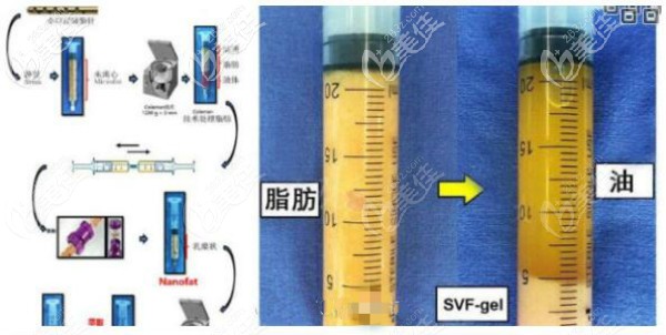 SVF脂肪膠和自體脂肪豐胸示意圖區(qū)別