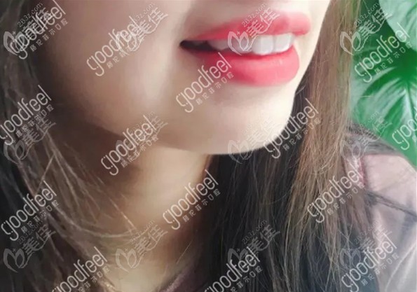 剛帶上牙套的圖片