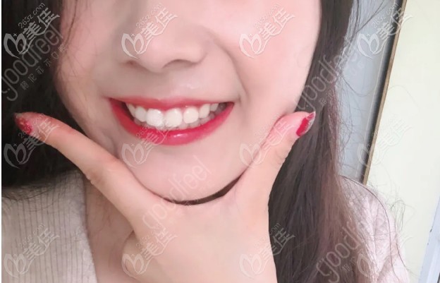 在深圳龍崗區(qū)格倫菲爾口腔戴時代天使透明牙套矯正我的小齙牙,不拔牙效果也很贊！