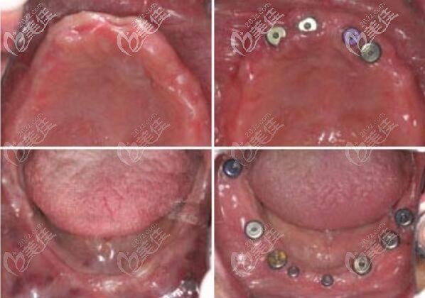 廈門峰煜口腔全口缺失案例 廈門峰煜口腔全口缺失案例