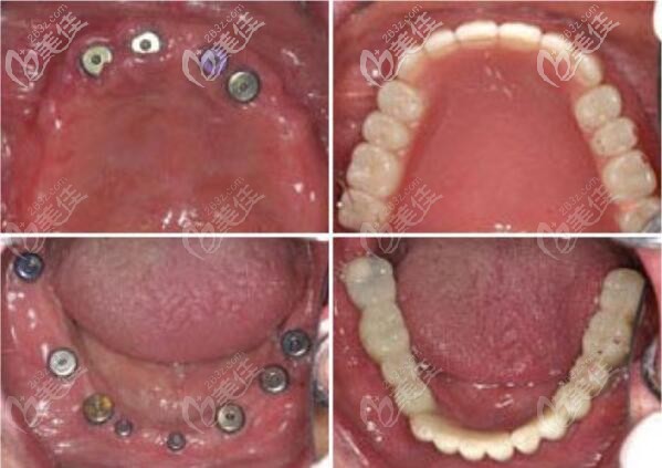 在區(qū)口腔用微創(chuàng)ALL-ON-4即刻種植牙技術做全口種植效果還不錯,61歲的王老伯說
