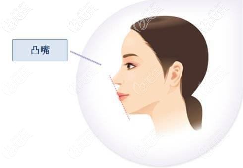 骨性凸嘴戴牙套有用嗎？