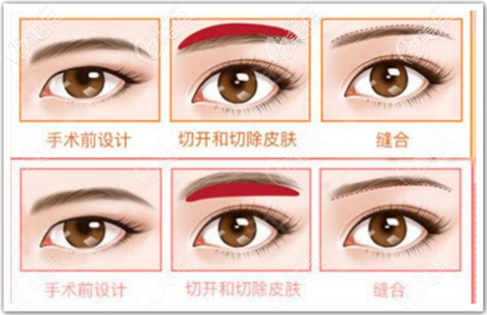 普通提眉手術(shù)方式有眉上和眉下切口