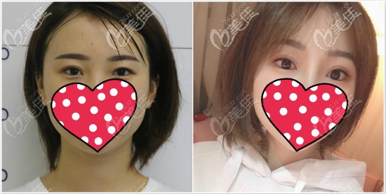 真人案例：提眉術(shù)前術(shù)后效果對(duì)比圖