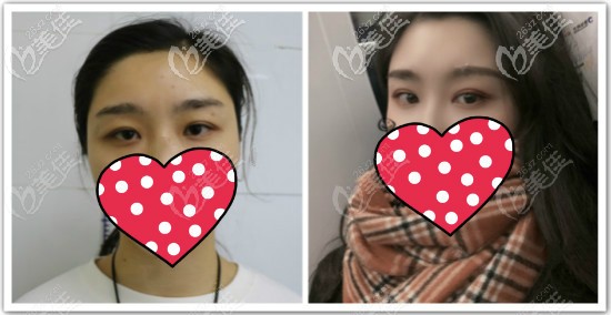 普通提眉手術(shù)前后效果對(duì)比圖片