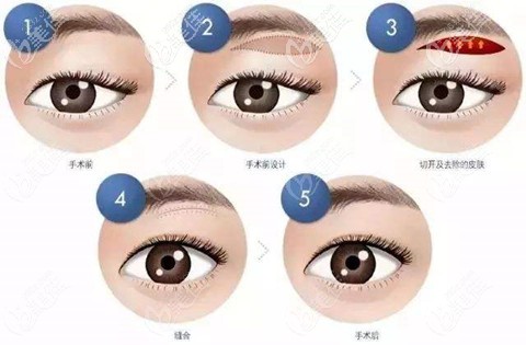 三層筋膜提美手術(shù)過程