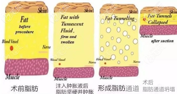 吸脂手術(shù)注射腫脹液的原因 吸脂手術(shù)注射腫脹液的原因