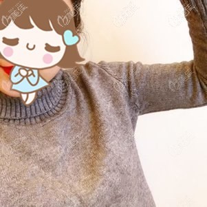 手臂吸脂術(shù)后20天腫脹漸消效果明顯 手臂吸脂術(shù)后20天腫脹漸消效果明顯