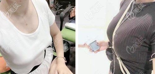 武漢藝星徐國建醫(yī)生假體隆胸案例 武漢藝星徐國建醫(yī)生假體隆胸案例