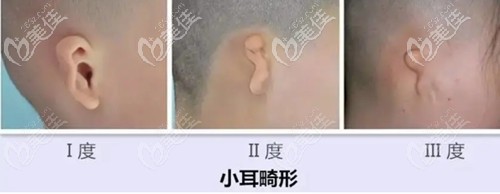 小耳畸形的程度 小耳畸形的程度