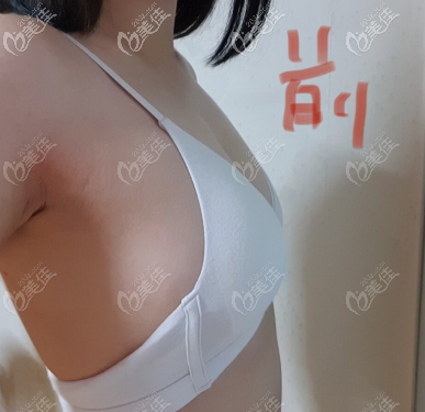 術(shù)前我的胸部照片 術(shù)前我的胸部照片