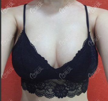 分享一則在韓國(guó)德新整形醫(yī)院做自體脂肪隆胸的案例