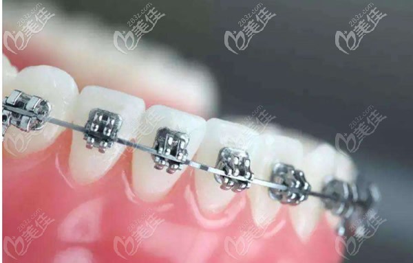 上門牙外突戴哪種牙套效果好