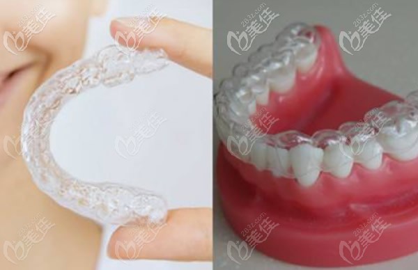 無托槽透明隱形牙套