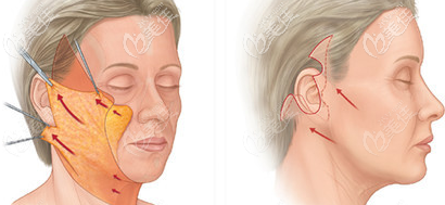柳京翰面部提升手術的示意圖