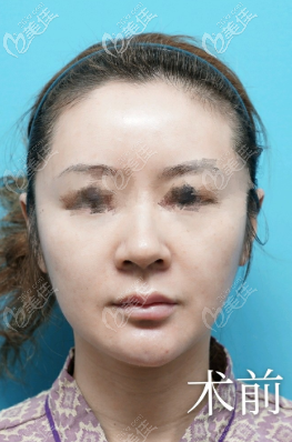 輪廓手術(shù)后面部下垂的圖片 輪廓手術(shù)后面部下垂的圖片