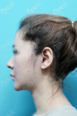 拆線后的側(cè)面照